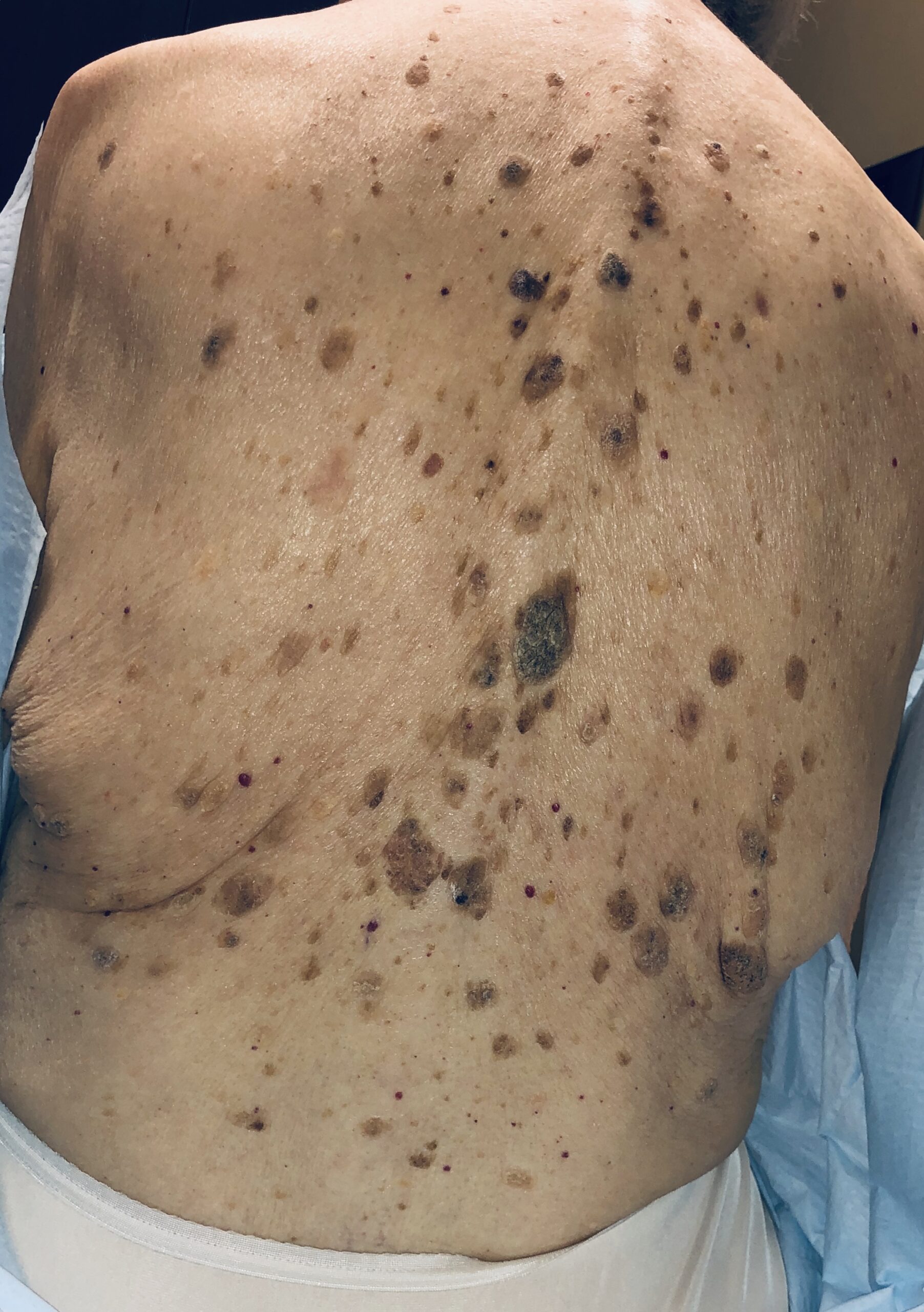 Multiple growths distributed across the back.