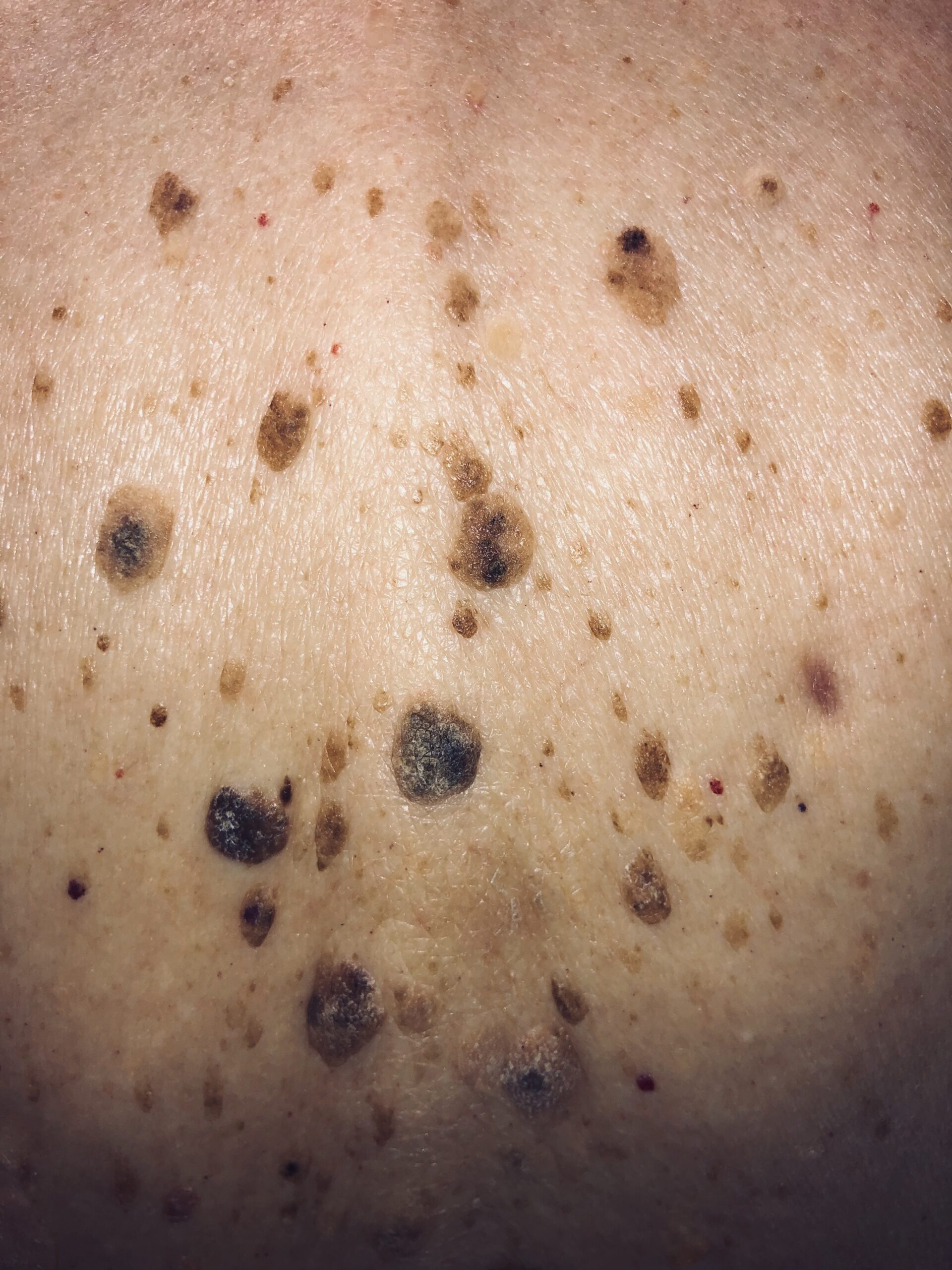 Brown and dark growths across the upper back.