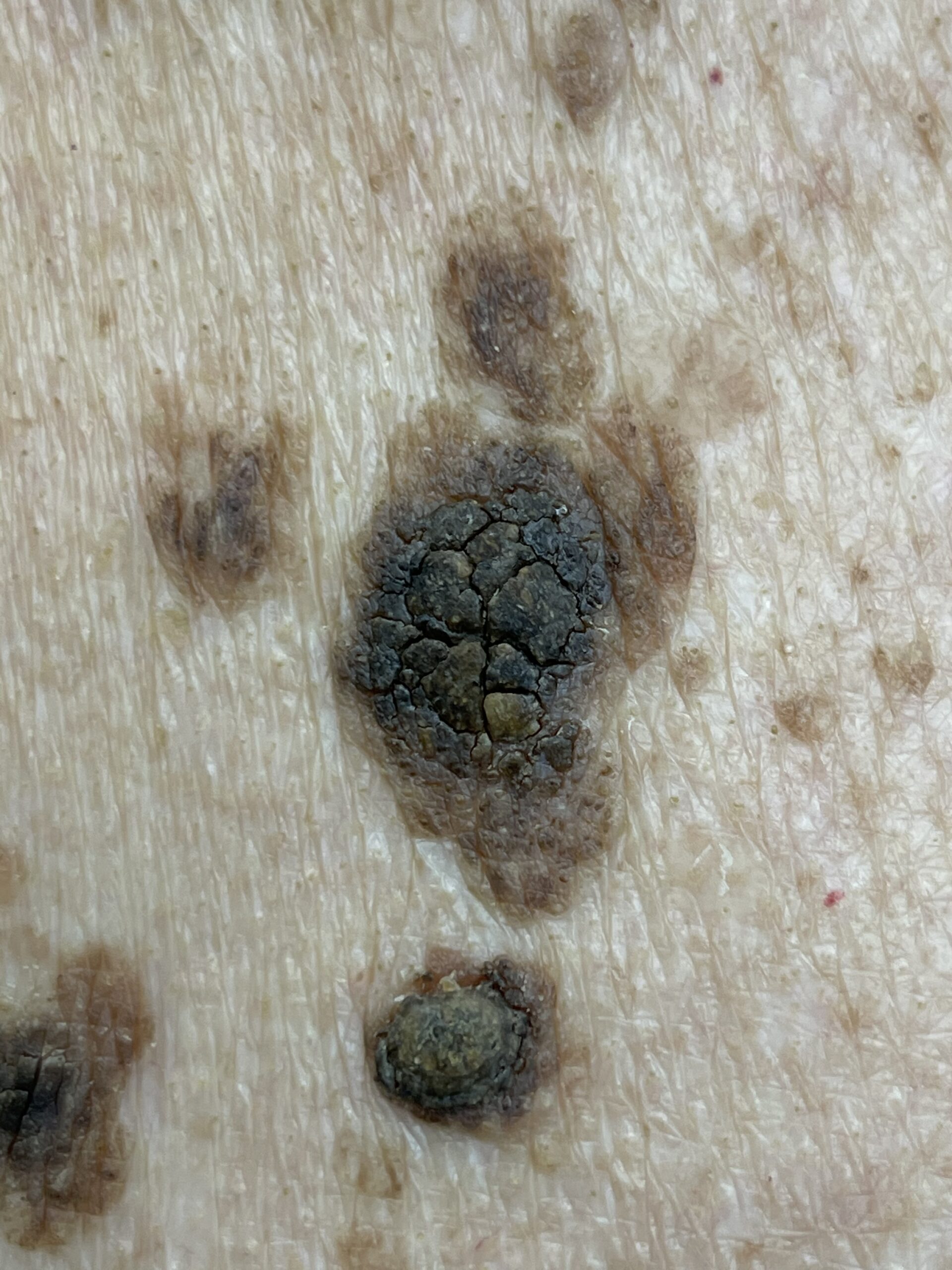 Clinical photograph of seborrheic keratoses at Kelowna Private Skin Cancer Clinic