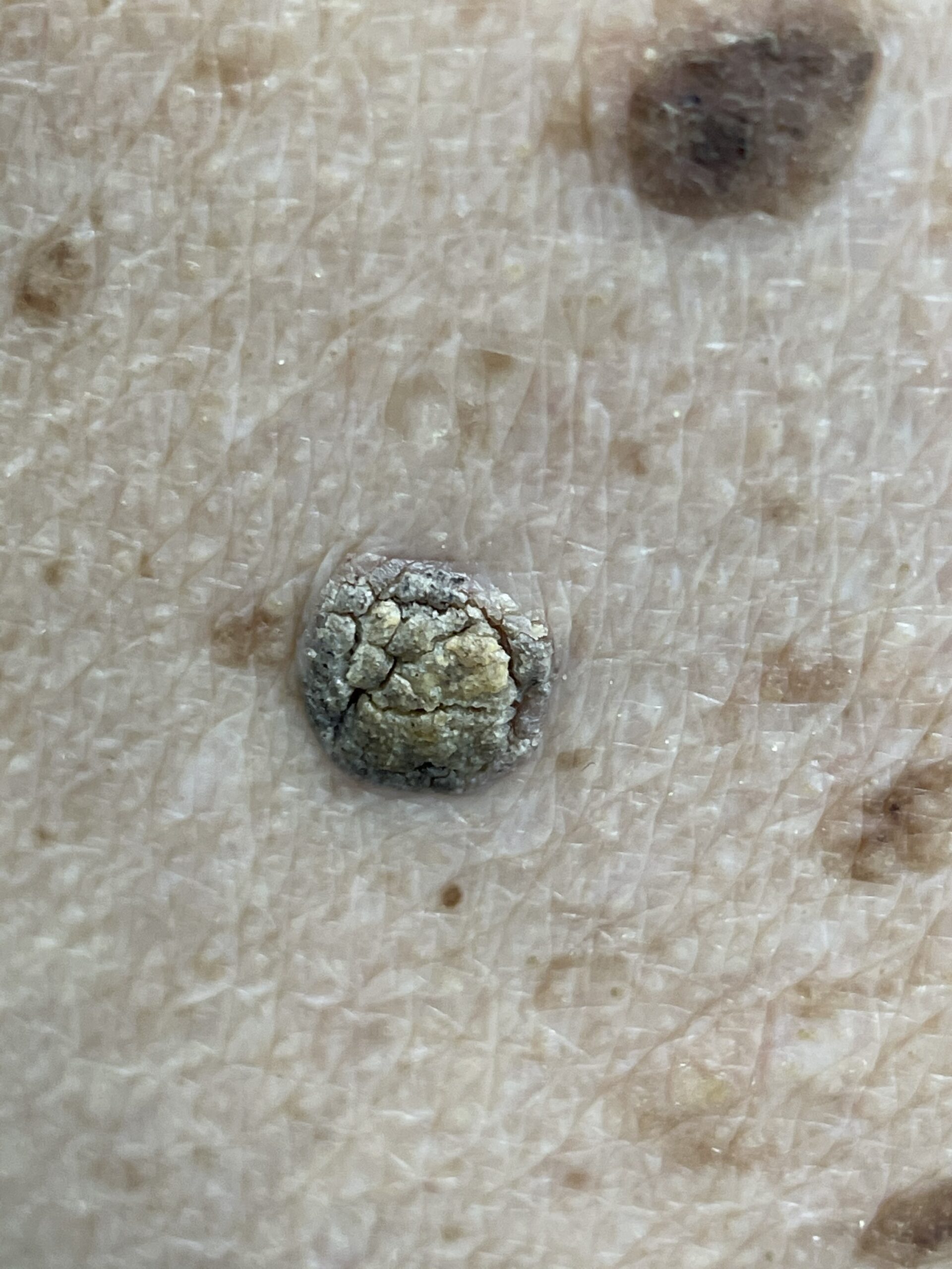 Close-up of a pale, crusted growth.