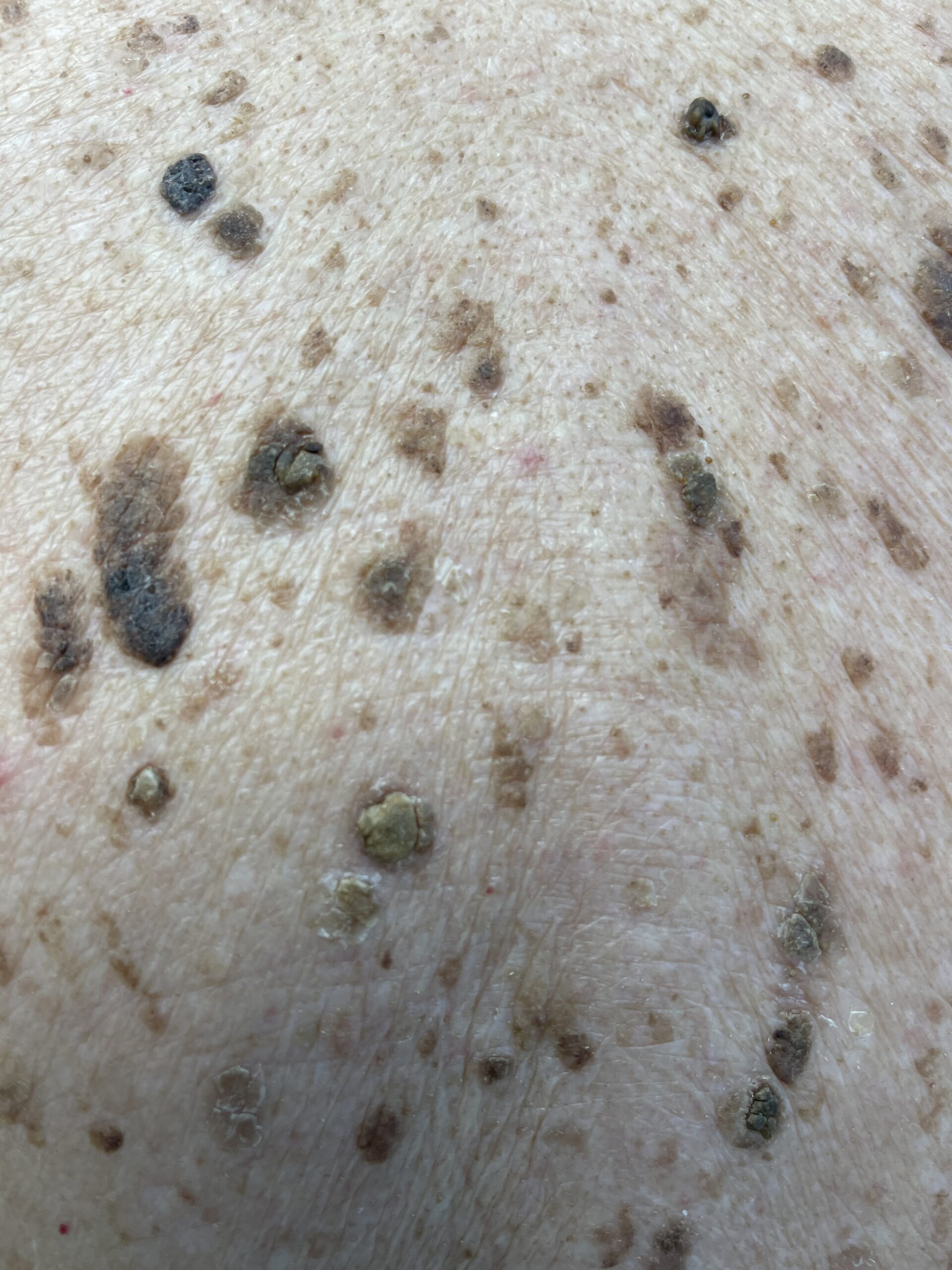 A cluster of small and larger raised growths.