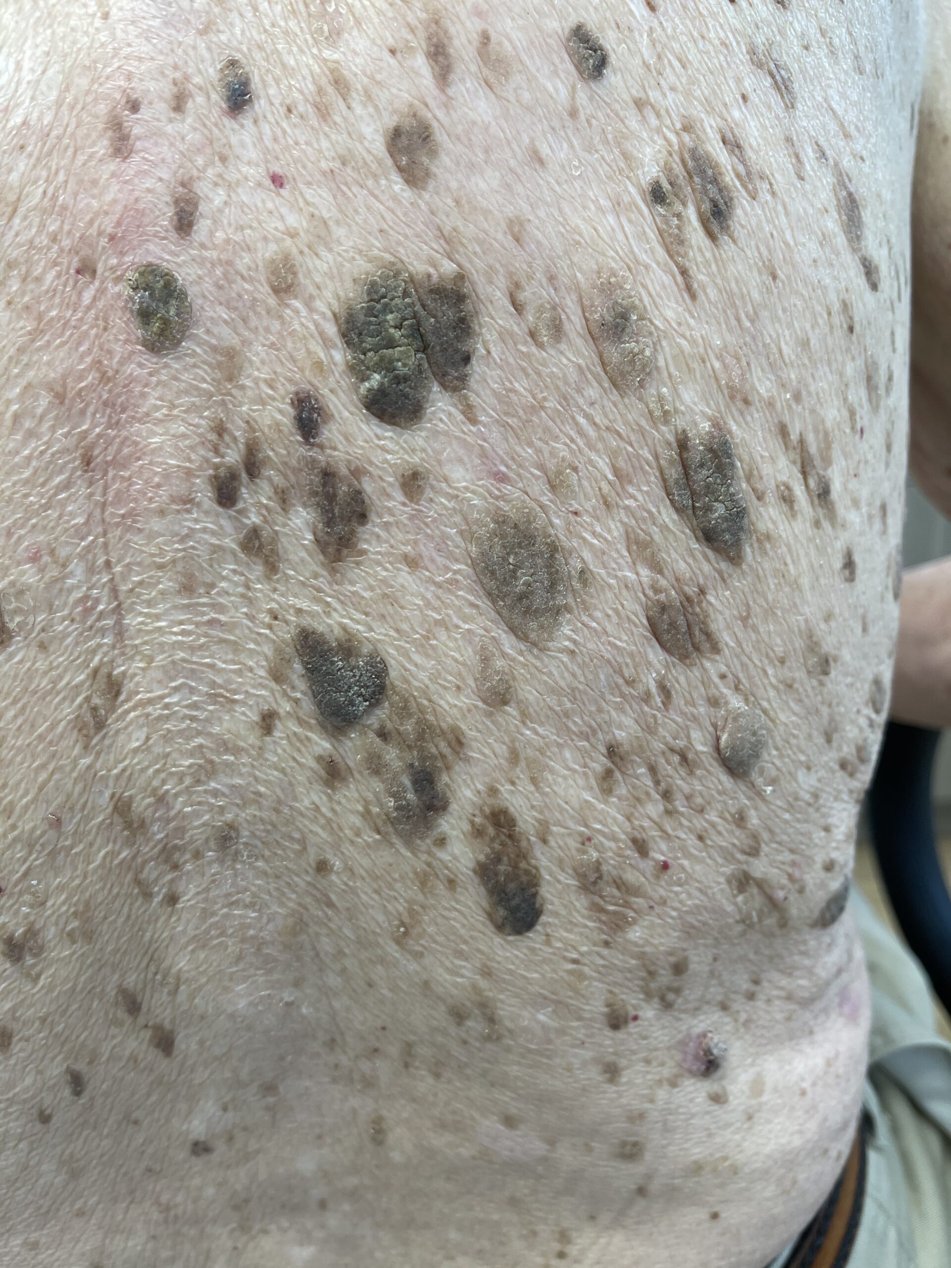 Raised growths of different sizes on the side of the torso.