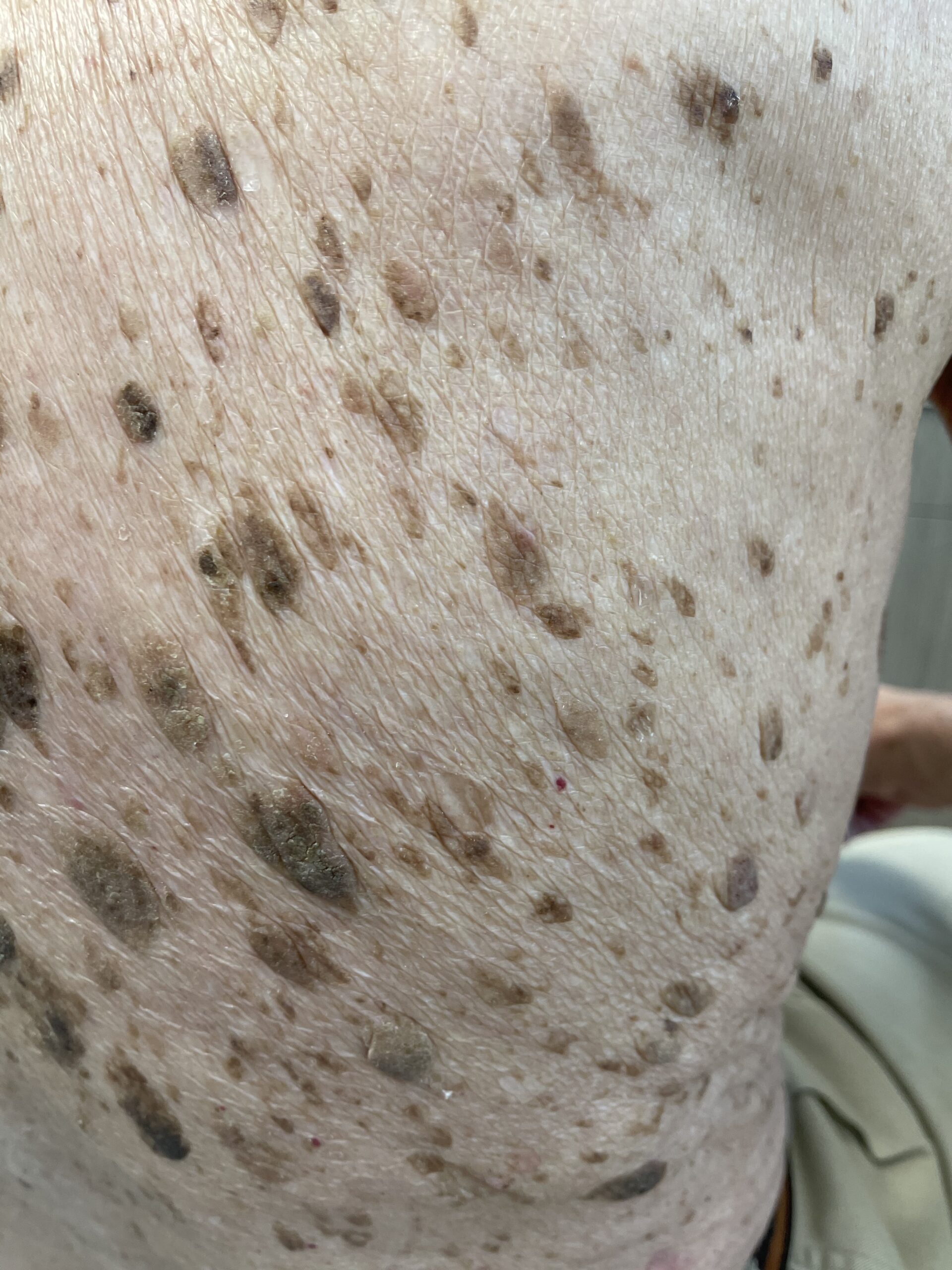 Wider view of growths along the side of the torso.