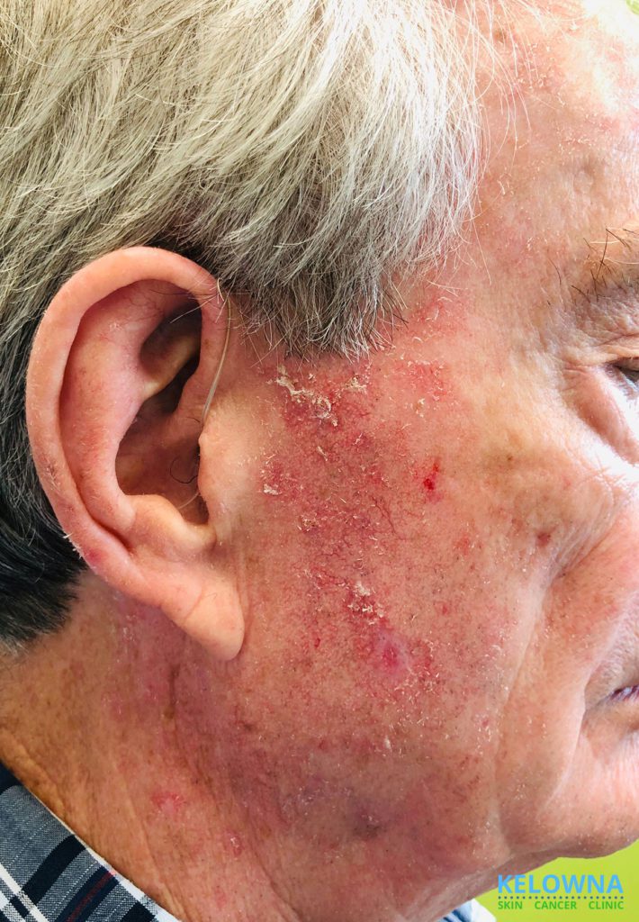 Side of an elderly man's face with advanced Actinic Keratosis..