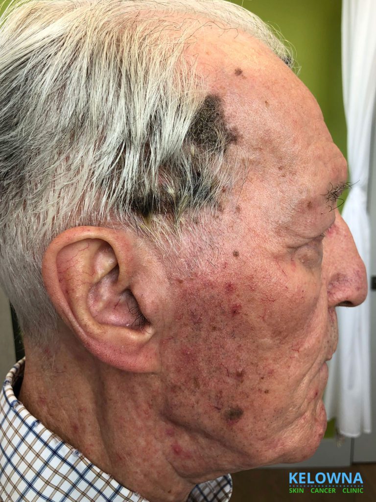 ial Fungal Infection on the side of an elderly man's hairline.