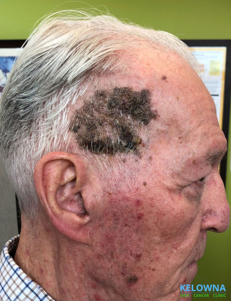 Non-malignant Seborrheic Keratosis with a Superficial Fungal Infection on the side of the head of a male senior.