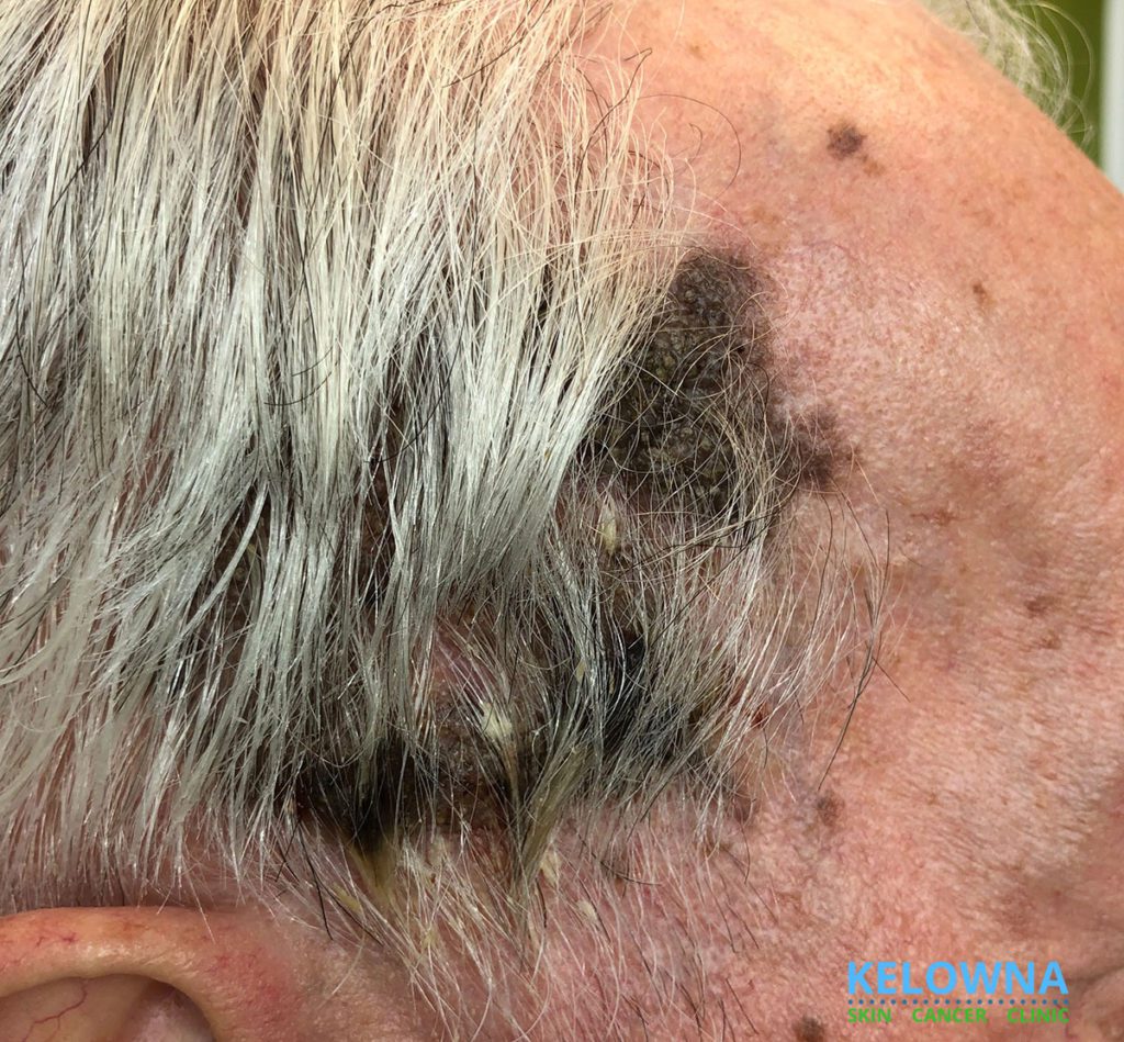 Close up of Seborrheic Keratosis with a Superficial Fungal Infection.
