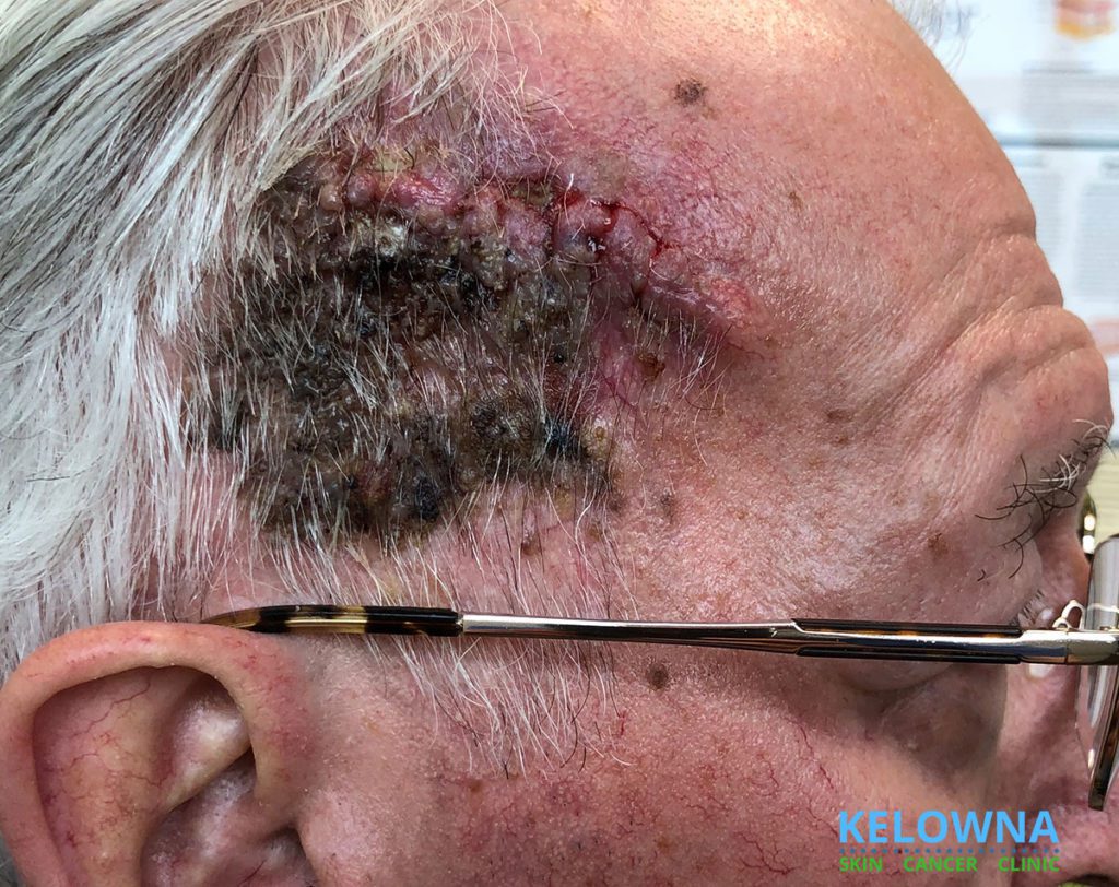 View of Seborrheic Keratosis with a Superficial Fungal Infection durig post-procedure suture removal.