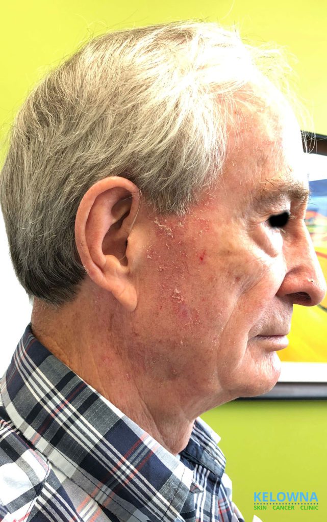 65 year old male with Actinic keratosis on his face.