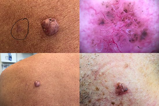 Four image collage with examples of the varying appearance of basal cell carcinoma.