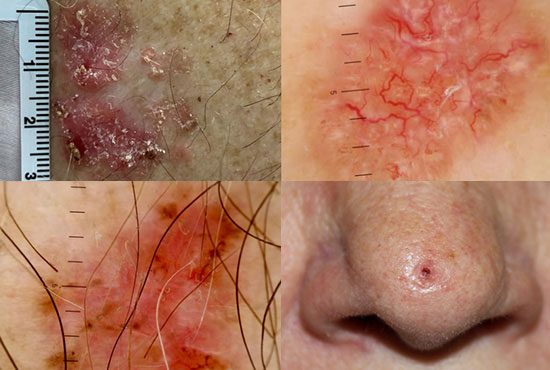 Four images in a grid showing cases of  basal cell carcinoma that are all unique in appearance.