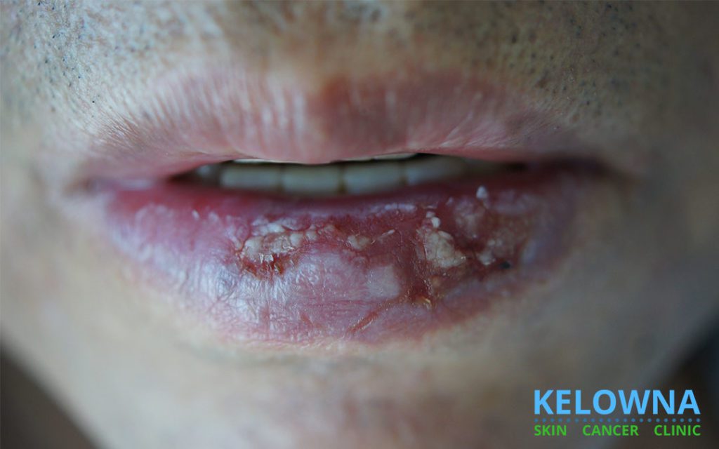 closeup of a mouth with chapped lips, showing Actinic cheilitis which is a form of Actinic keratosis that occurs on the lips