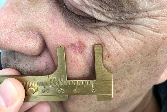 Clinical information about actinic keratosis