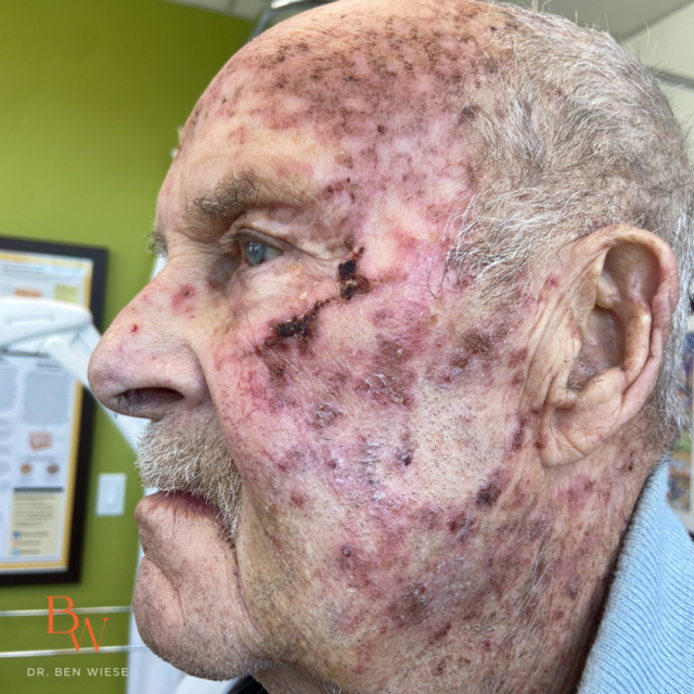 Facial skin response during topical chemotherapy with Efudex (5-FU).