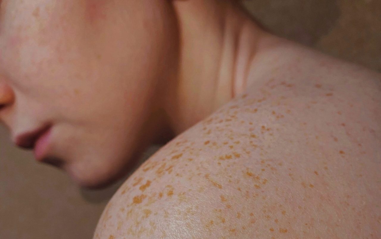 Are You at Risk for Developing Skin Cancer?