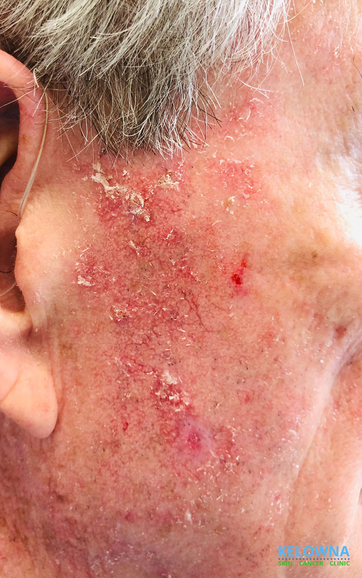 Actinic keratoses visible on the face and scalp of an older male patient. Treatment options may include daylight-activated field therapy.
