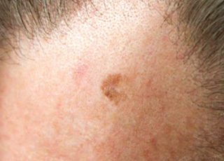 Clinical example: Lentigo Maligna Melanoma