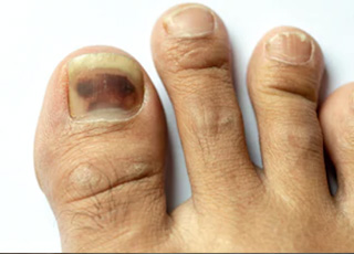 Clinical example: Subungual Melanoma