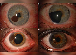 Clinical example: Uveal melanoma
