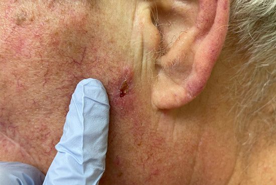 Clinical information about squamous cell carcinoma