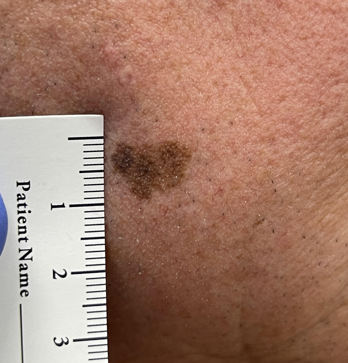 A brown skin spot with an uneven outline beside a measurement ruler.