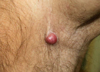Clinical example: Nodular Melanoma