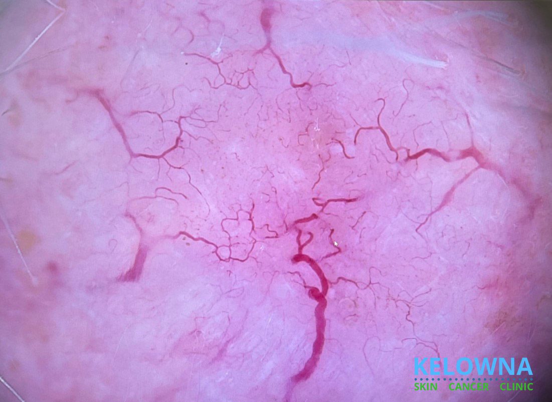 Invasive micronodular basal cell carcinoma, dermoscopic view