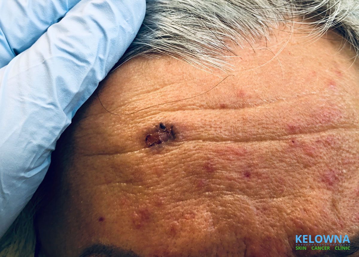 Basal cell carcinoma on the forehead 