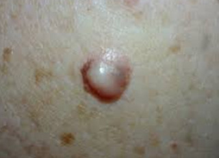Clinical example: Desmoplastic Melanoma