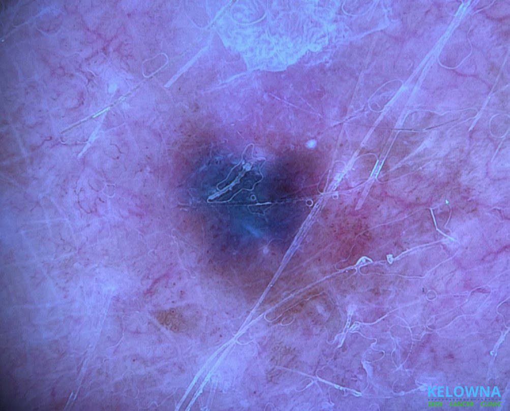 Malignant melanoma in situ (lentigo maligna type) with an adjacent blue nevus.