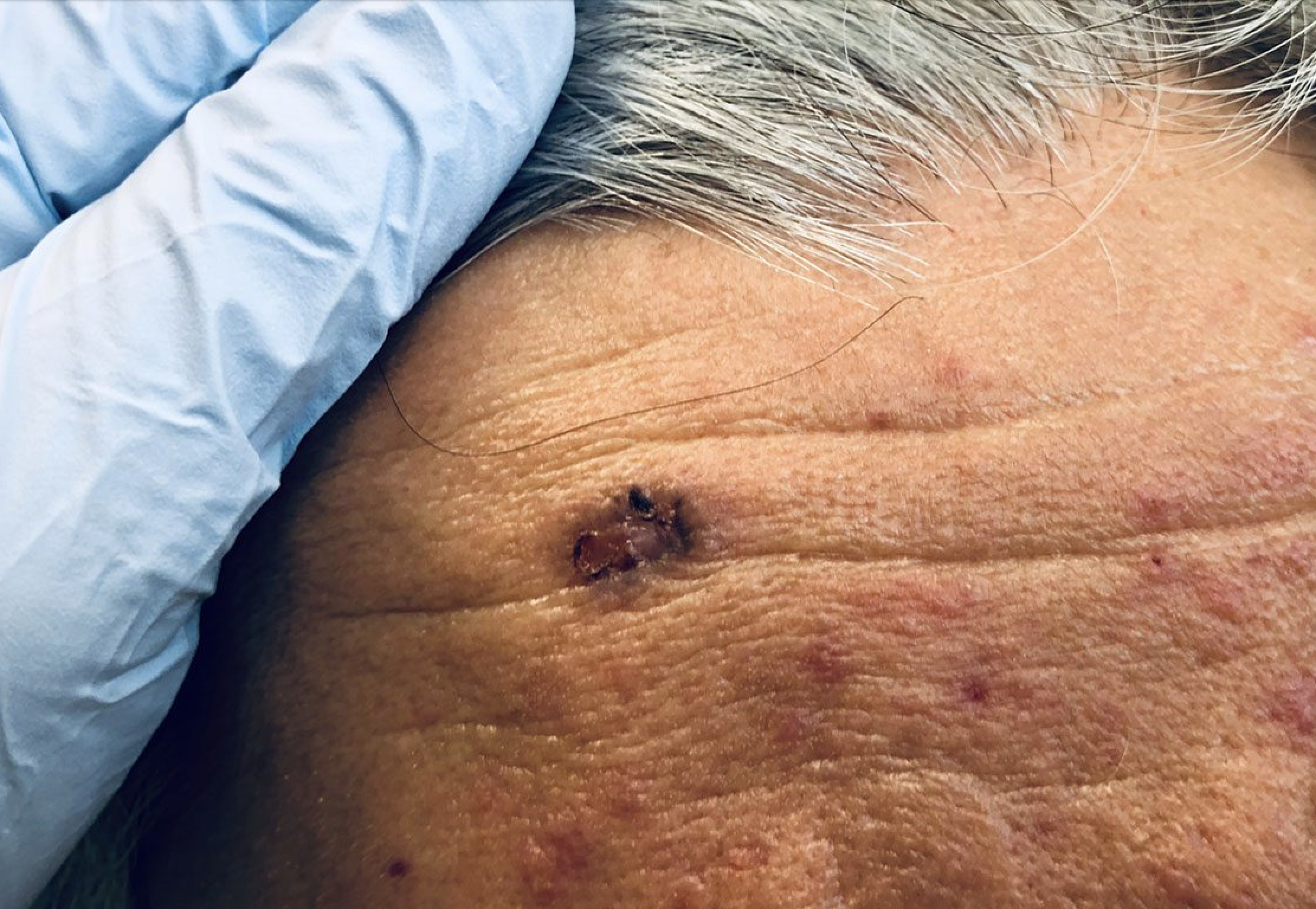 Basal cell carcinoma