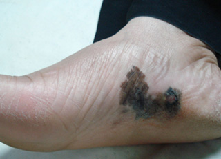 Clinical example: Melanoma Acral Lentiginous