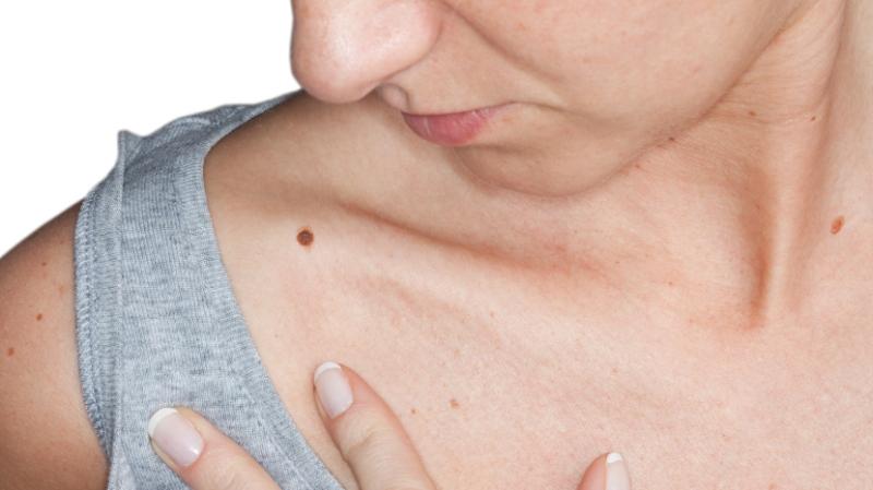 A woman looks at a mole on her shoulder.