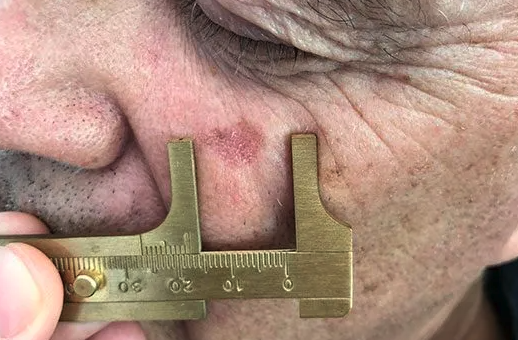 one of dr ben wiese's patients with an actinic keratosis lesion on their cheek, being measured by gold calipers