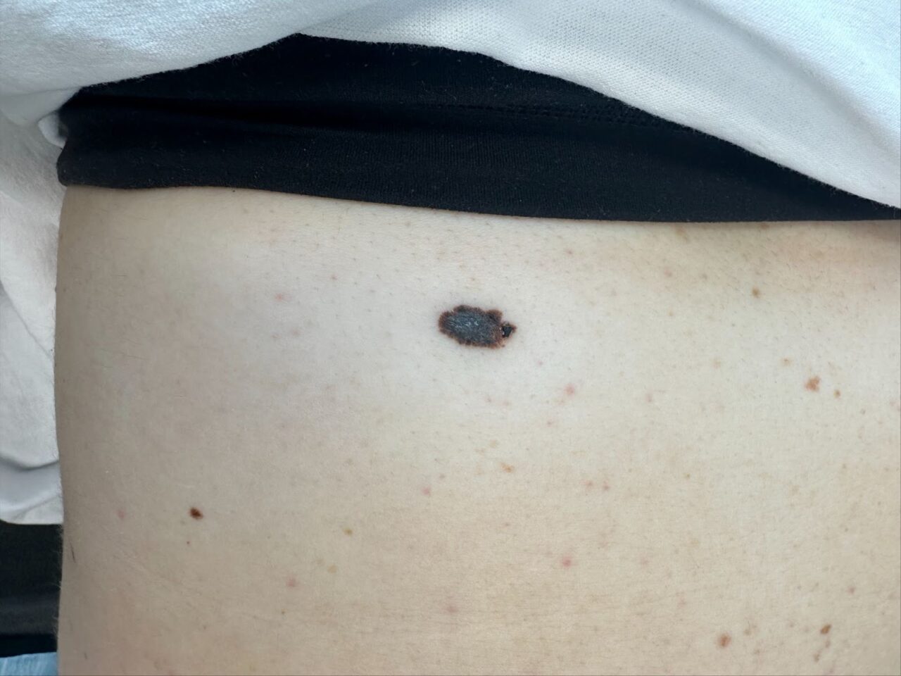 A dark oval skin spot on a person's upper back.