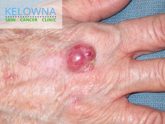 Clinical example of Merkel cell carcinoma