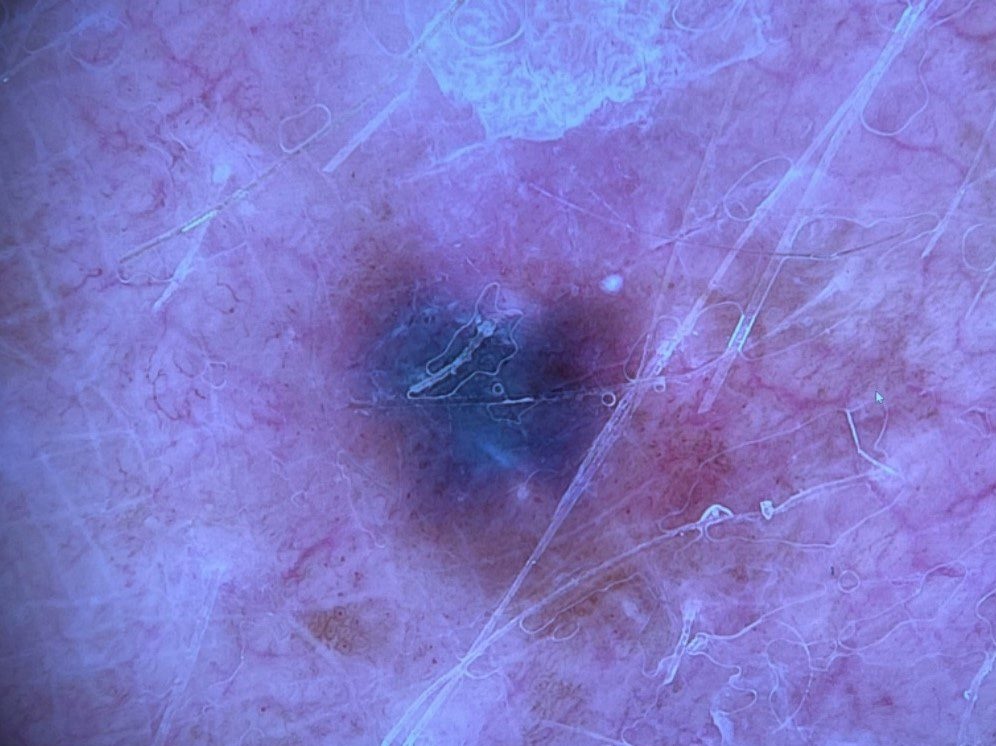 a photo taken with a dermoscope of melanoma skin cancer