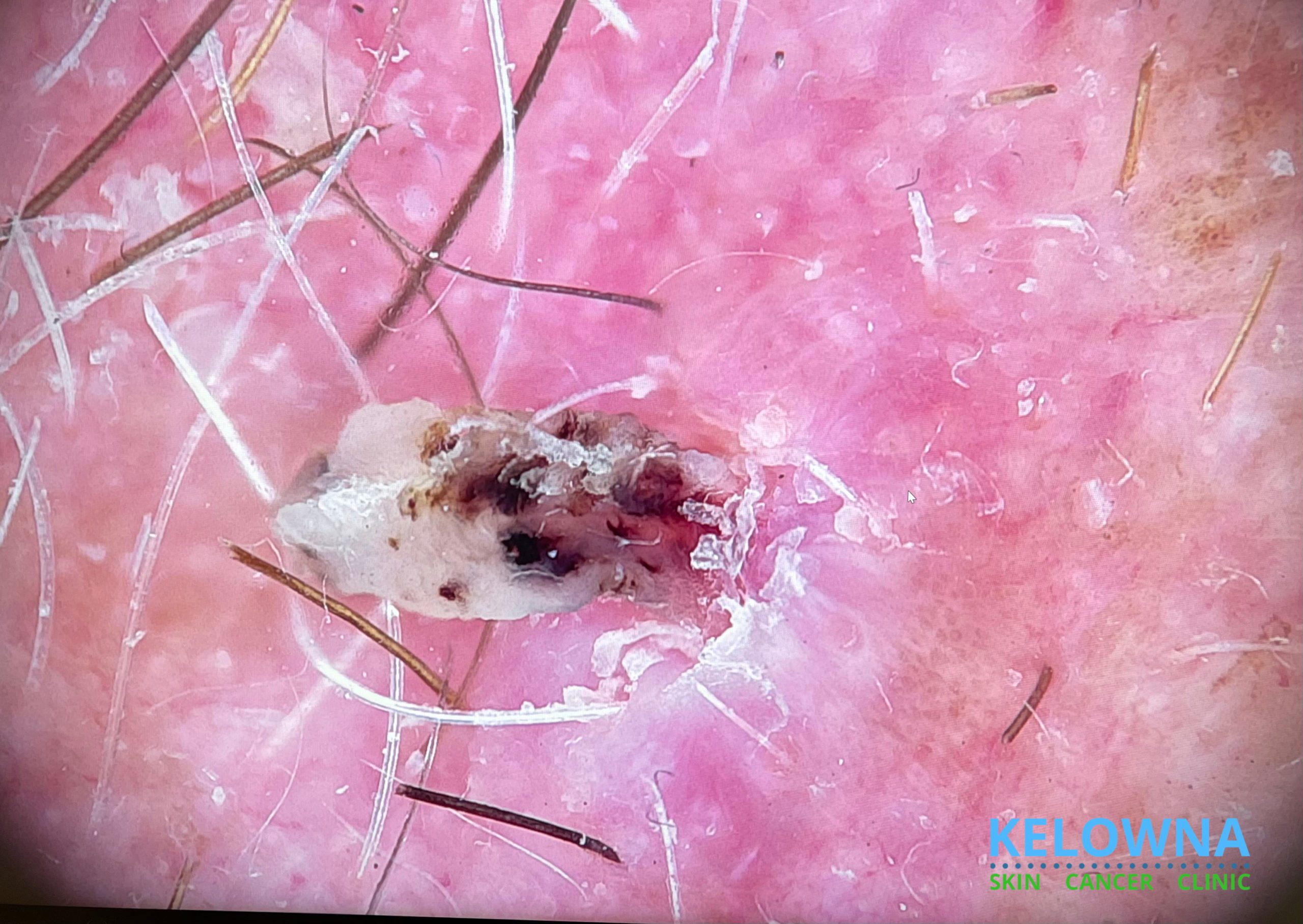 Moderately differentiated invasive squamous cell carcinoma, dermoscopic view