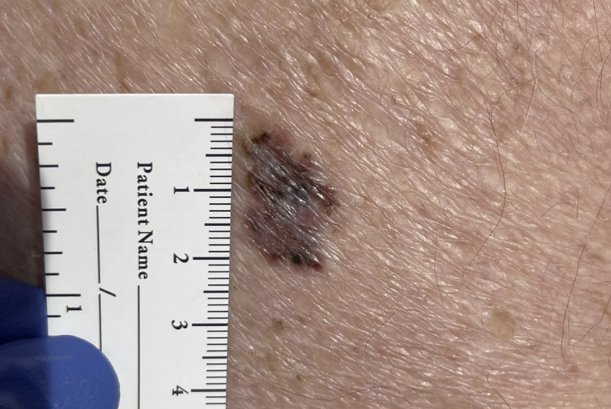 Suspicious Moles: What to Watch For and When to Get Checked