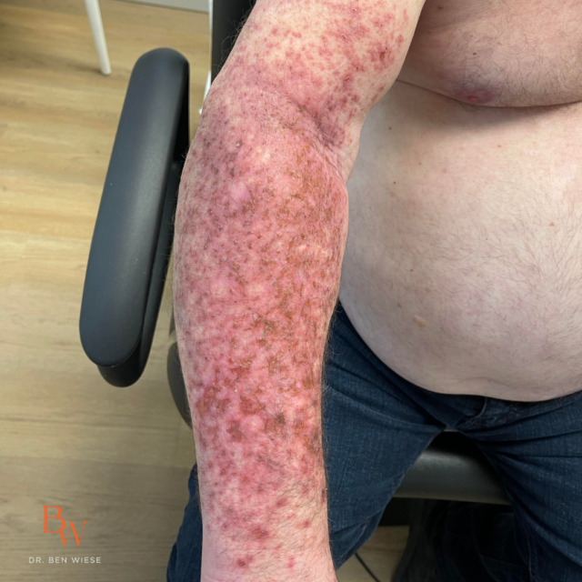 Forearm skin response during topical chemotherapy with Efudex (5-FU).