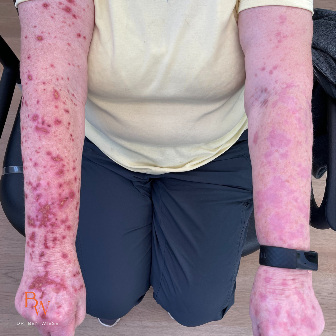 Skin response across an area treated with topical chemotherapy.