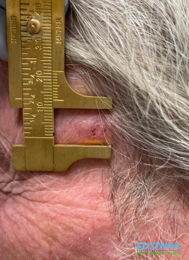 Invasive squamous cell carcinoma with 1.5 mm depth of invasion.