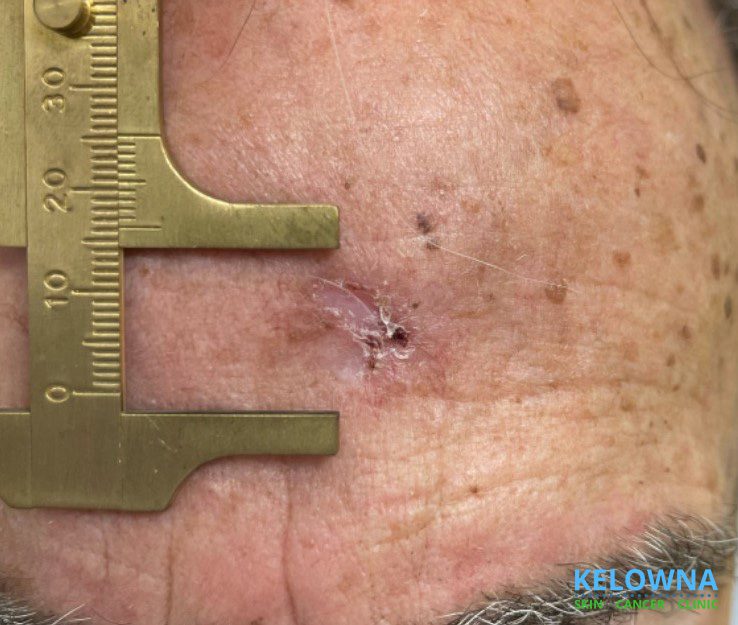 Clinical view of two basal cell carcinomas: nodular and infiltrative subtypes.