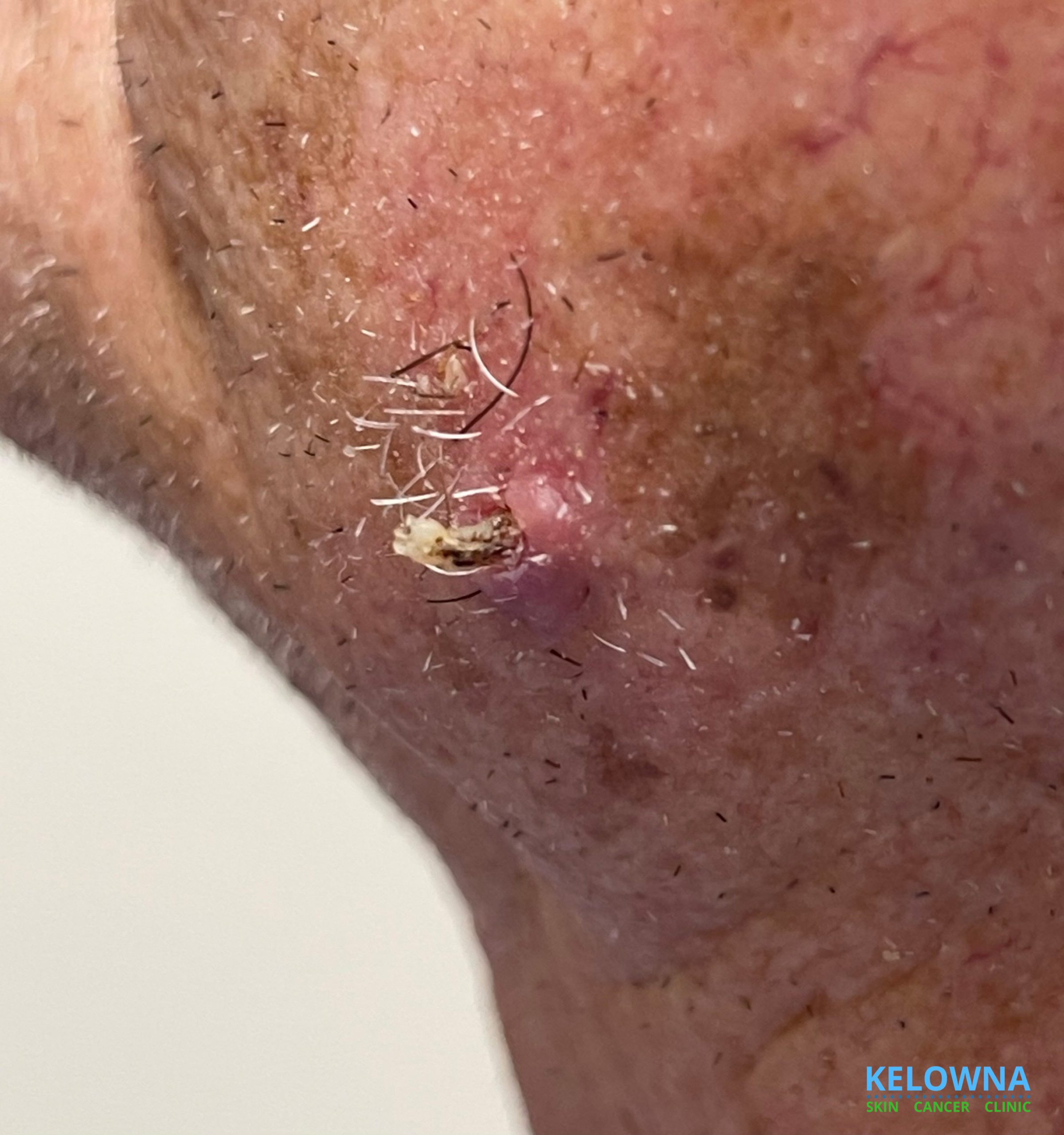Moderately differentiated invasive squamous cell carcinoma, clinical view