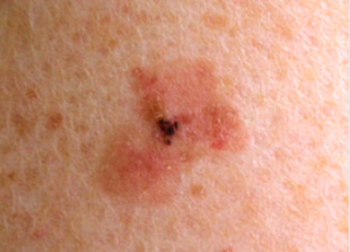 Clinical example: Superficial Spreading Melanoma