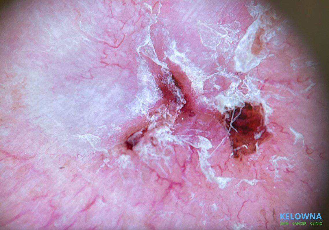 Dermoscopic view of two basal cell carcinomas: nodular and infiltrative subtypes.
