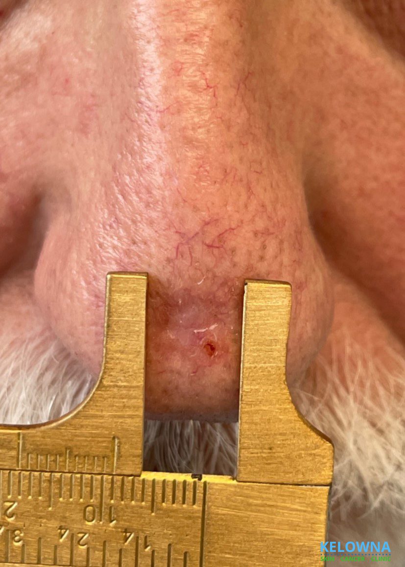 Clinical view of a morpheaform basal cell carcinoma.
