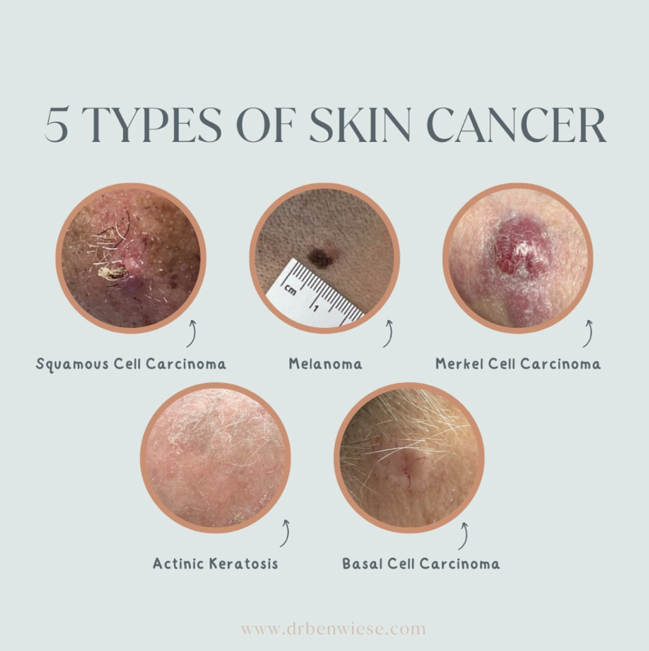 an infographic showing circle images of the five types of skin cancer, including squamous cell carcinoma, melanoma, merkel cell carcinoma, actinic keratosis and basal cell carcinoma