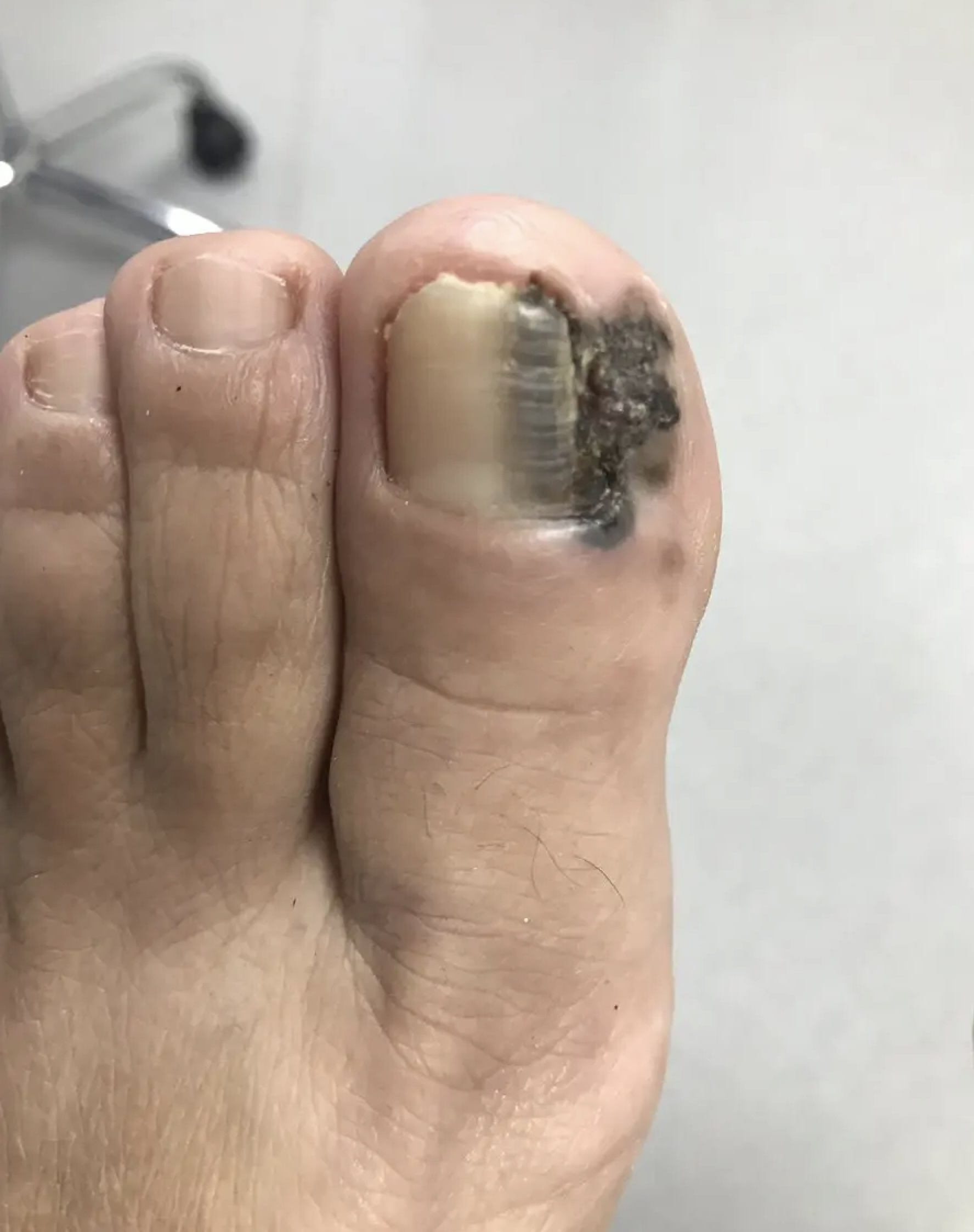 Melanoma