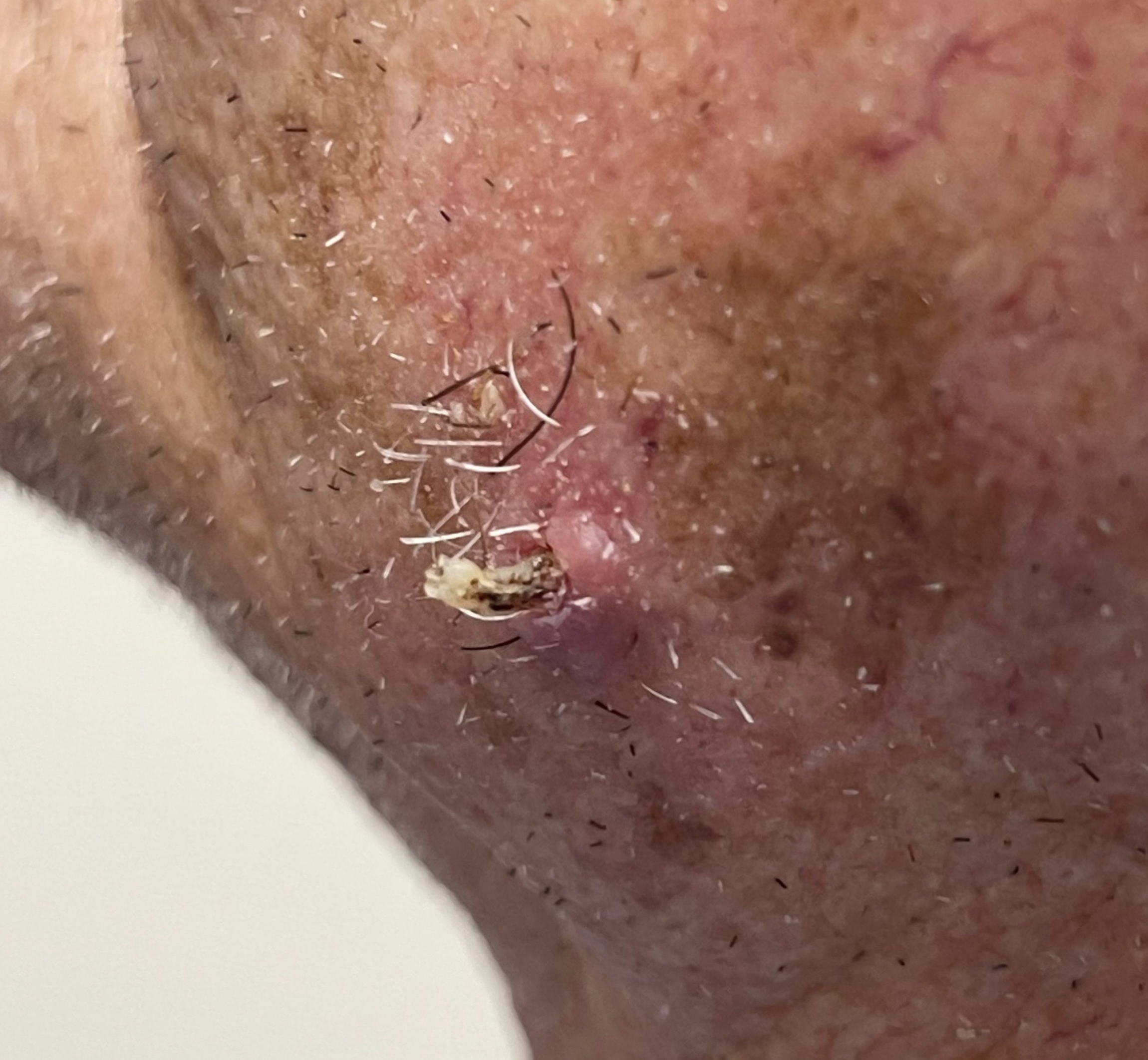 Squamous cell carcinoma